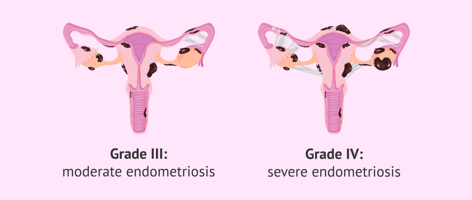 Grade Iii And Iv Endometriosis