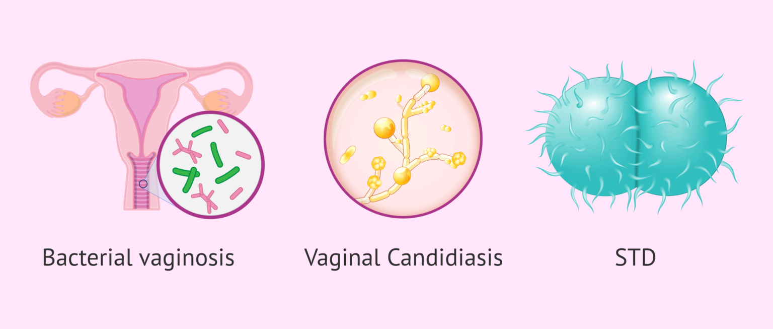 Possible Causes Of Abnormal Vaginal Discharge