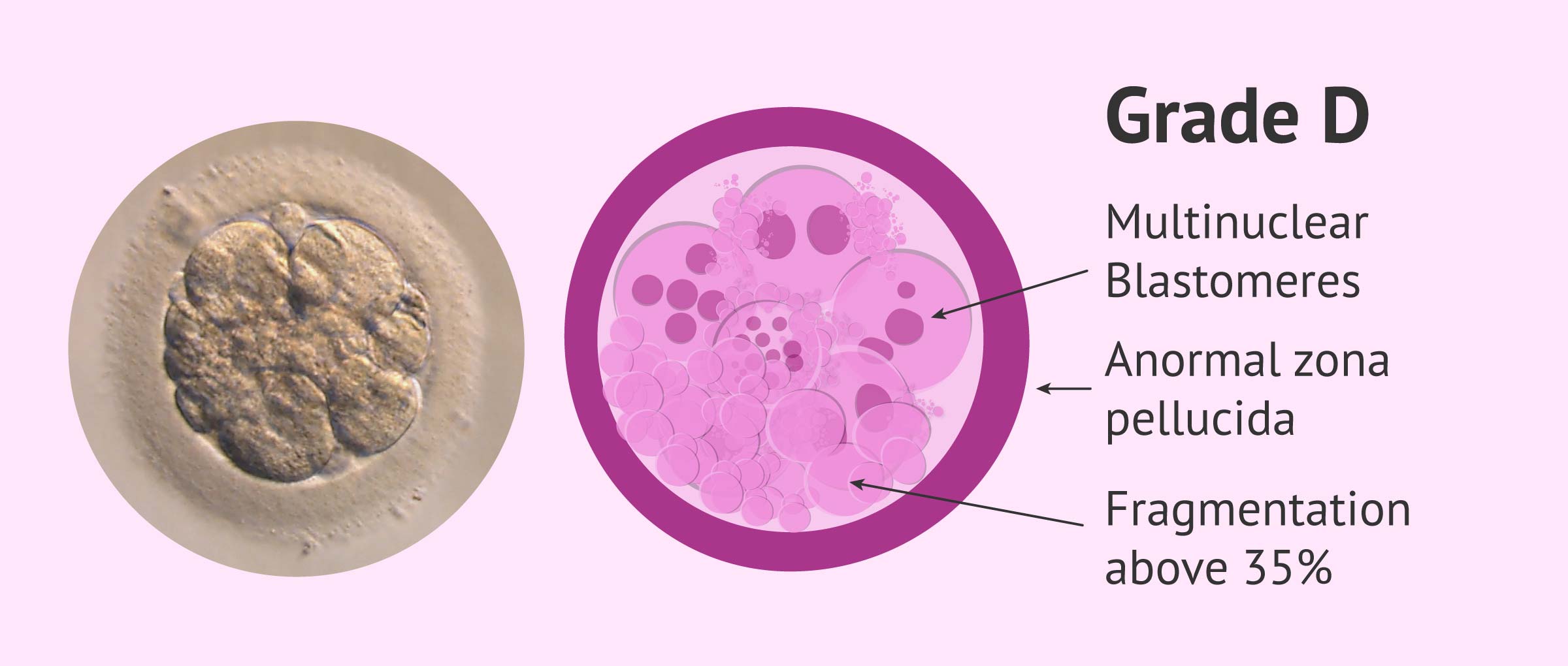 Embryo Quality Grading Does It Affect IVF Success 