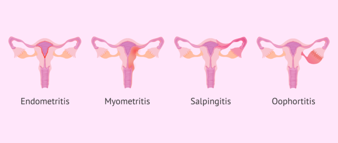 Types of pelvic inflammatory diseases (PID)