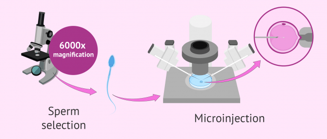 How does IMSI IVF work?