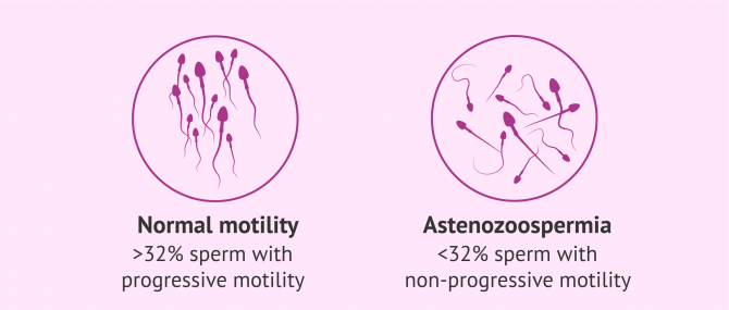 Imagen: ICSI to treat asthenozoospermia or abnormal sperm motility