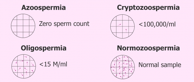 Diagnosis of azoospermia