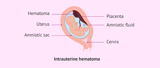 Imagen: Intrauterine hematoma