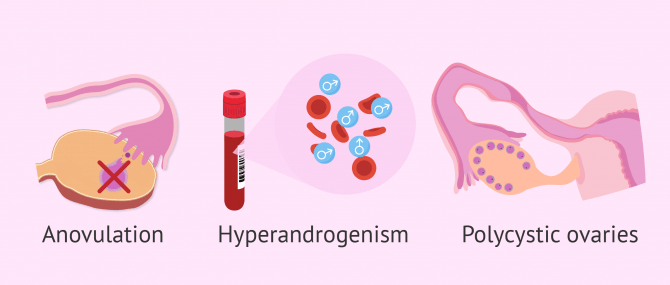 Diagnosis of PCOS with Rotterdam criteria