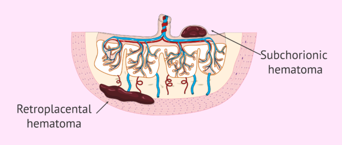 Imagen: Types of intrauterine hematomas