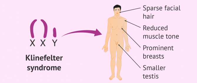 Symptoms of Klinefelter syndrome