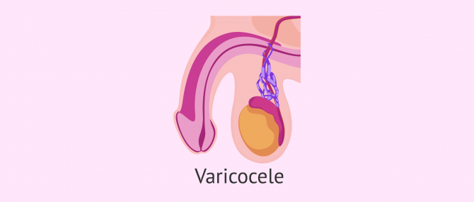 What is a varicocele?