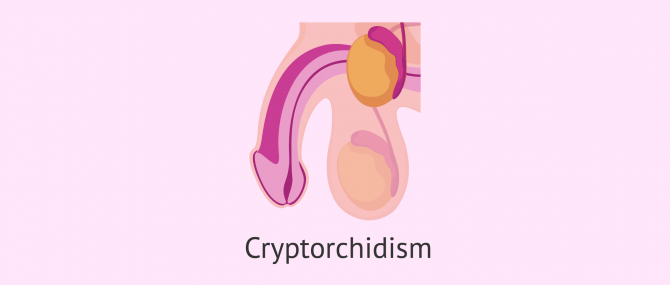 What is cryptorchidism?