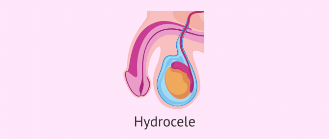 What is a hydrocele?