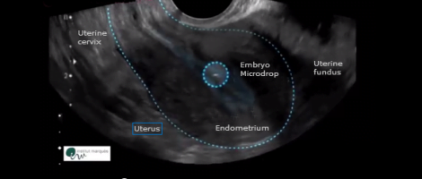 Embryo drop way to fundus