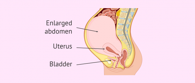 Abdominal extension during false pregnancy or pseudocyesis