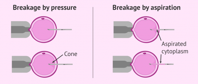 Imagen: ICSI Breakage