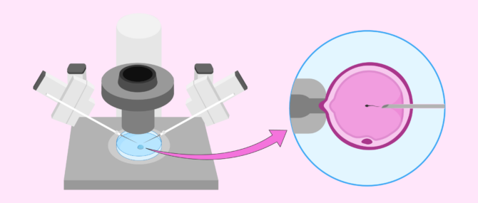 Injecting sperms into the ovum