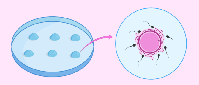 IVF petri dish with eggs and sperm