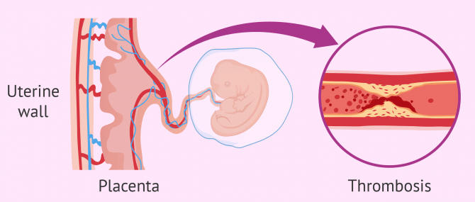 Antiphospholipid syndrome and recurrent miscarriage