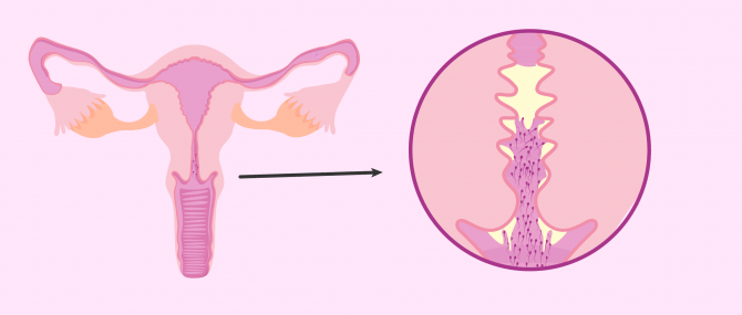 Female infertility due to antisperm antibodies