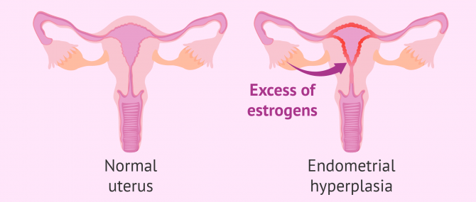 What is endometrial hyperplasia?