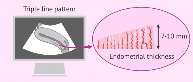 Ideal endometrial thickness to get pregnant