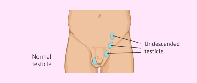 Imagen: What is cryptorchidism