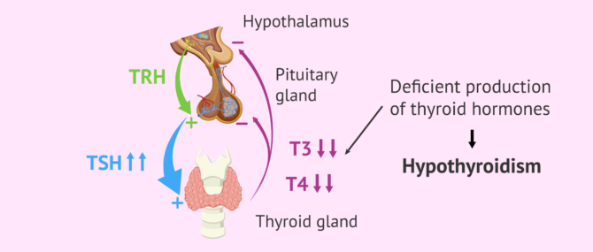 Imagen: Female thyroid gland failure