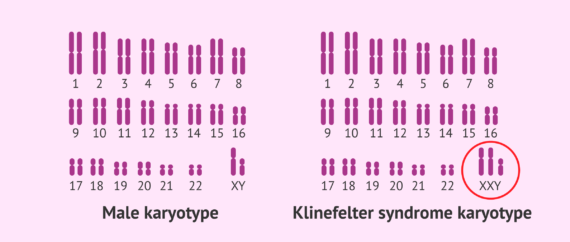 Normal karyotype and Klinefelter syndrome