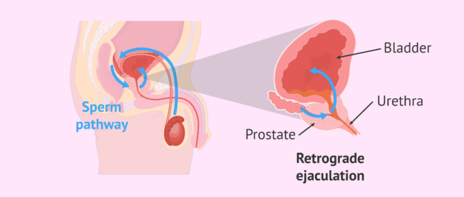 Imagen: Retrograde ejaculation process