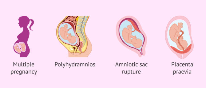 Imagen: Risk factors during pregnancy for preterm delivery