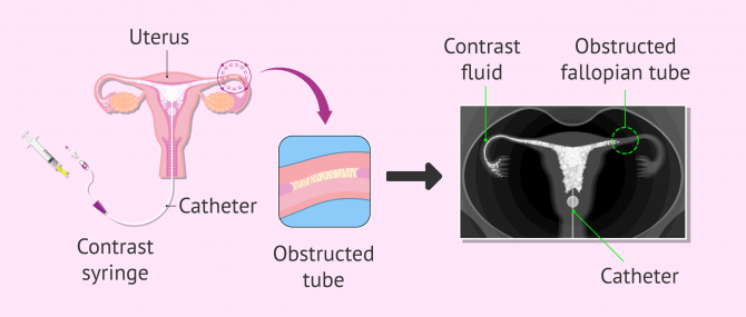 Imagen: Observation of the fallopian tubes by hysterosalpingography