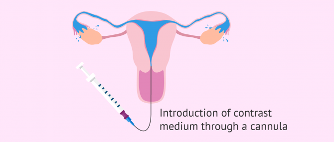 Imagen: Hysterosalpingogram