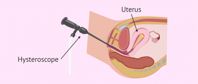 Imagen: Hysteroscopy