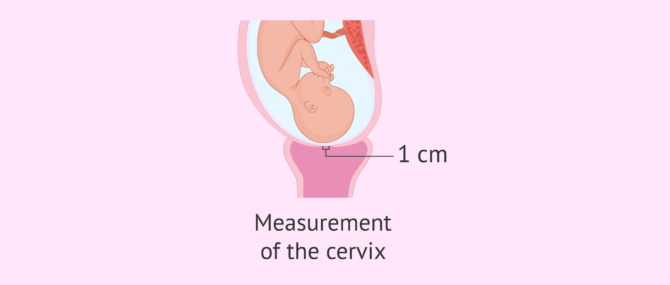 Imagen: How long is the cervix in preterm labour?