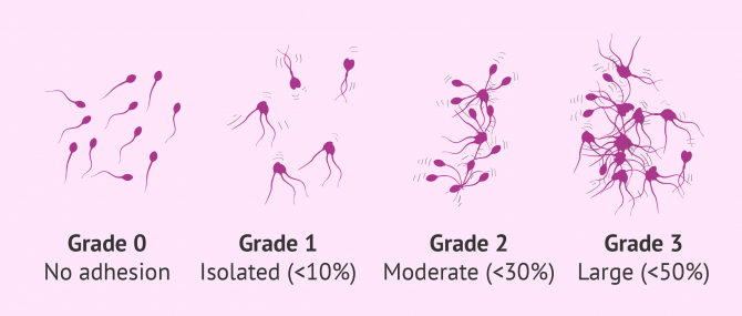 Imagen: Degrees of sperm agglutination