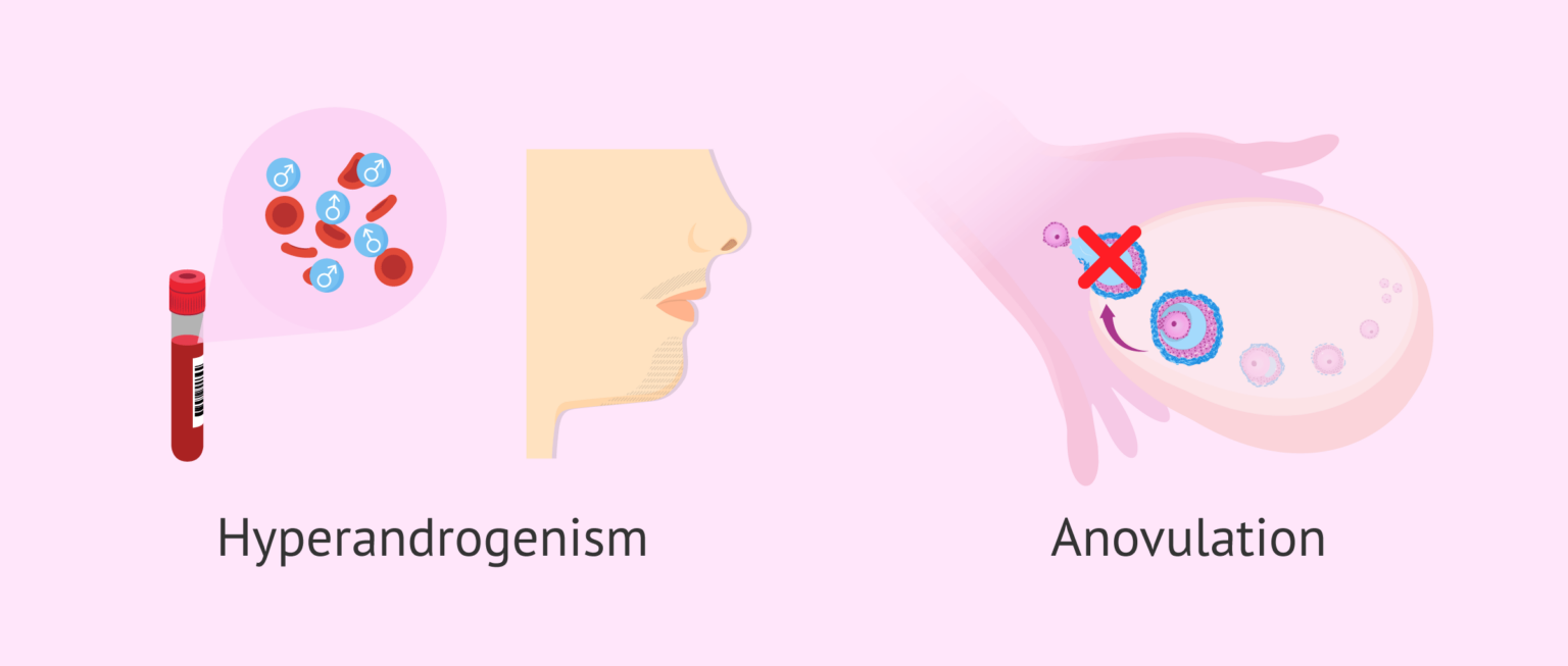 Manifestations of PCOS