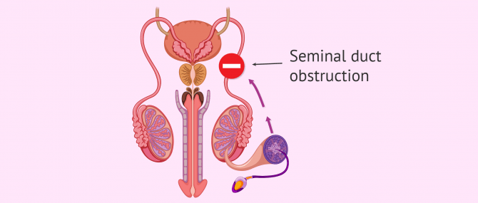 Imagen: Seminal Duct Obstruction