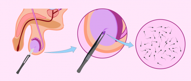 Imagen: Biopsy of testicles