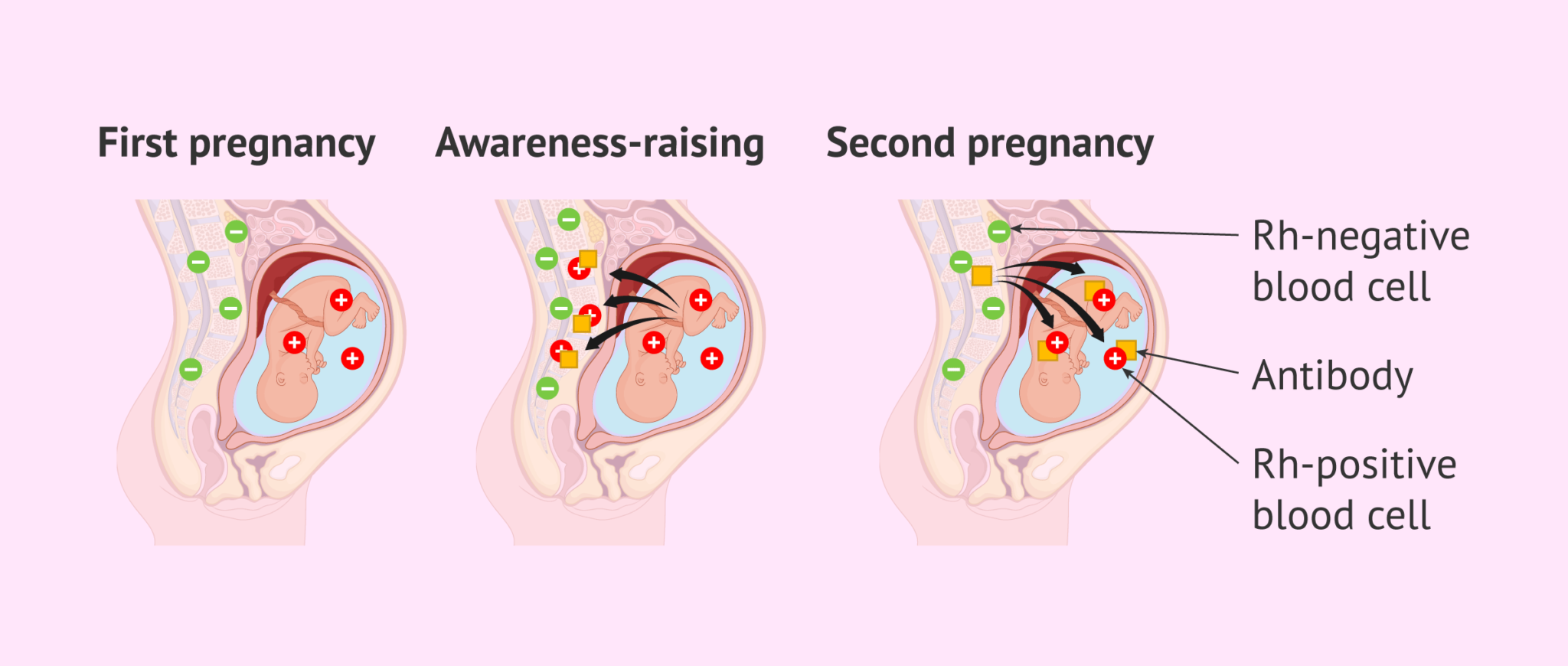 what-is-the-28-week-anti-d-vaccine-for