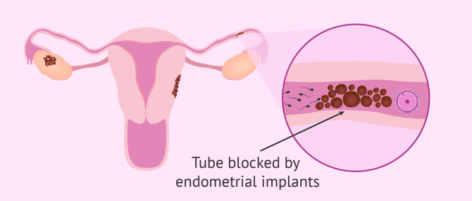 Imagen: Fallopian tube blocked by endometrial implants