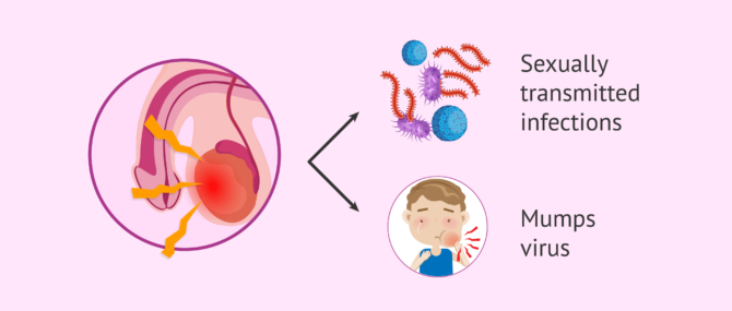 Imagen: Orchitis and its causes