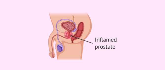 Imagen: Inflammation of the prostate gland or prostatitis