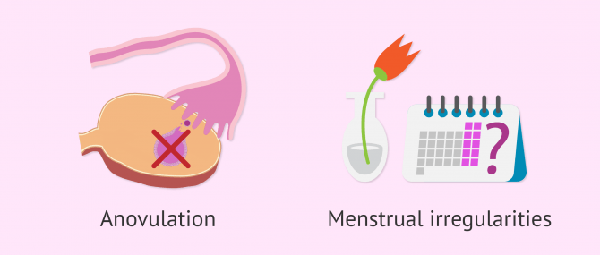 Infertility and polycystic ovaries