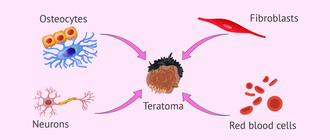 What are teratomas composed of?