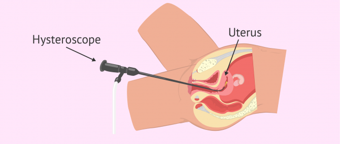 Hysteroscopy for fertility