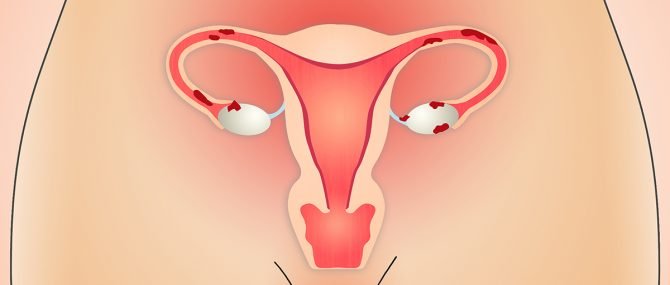 Female infertility