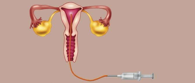 Donor sperm insemination