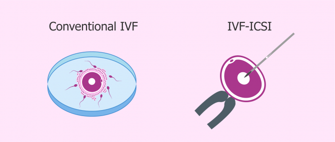 Types of in vitro fertilization available today