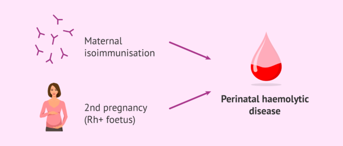 Imagen: Problems in second pregnancy due to maternal Rh isoimmunisation