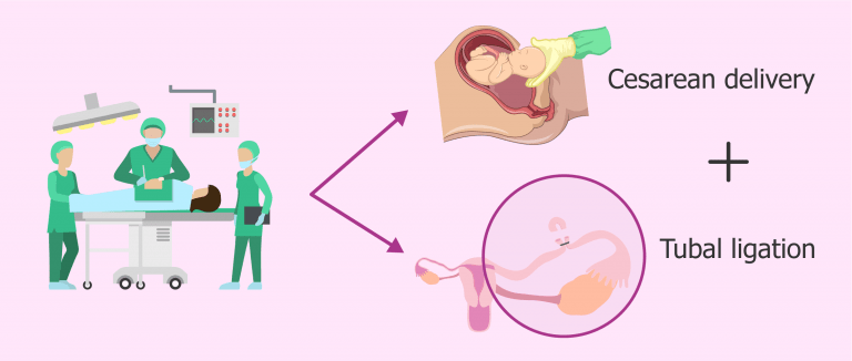 heavy bleeding after c section and tubal ligation