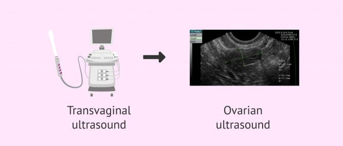 Imagen: Antral follicle count by transvaginal ultrasound scanning