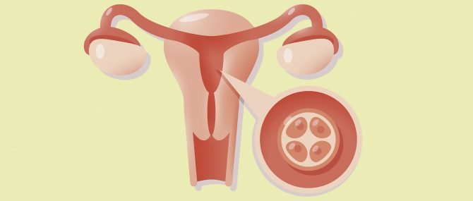 Placing the embryos inside the uterus